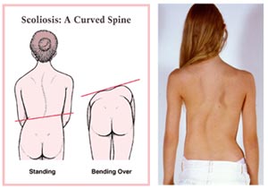 รับออกแบบโปรแกรมออกกำลังกายสำหรับผู้ที่เป็นกระดูกสันหลังคด(scoliosis) 