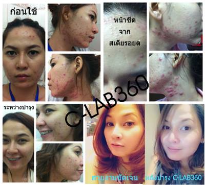 ครีมหน้าใส-c-lab-ลดสิวอักเสบ-สิวอุดตัน-ผิวสวย-ผิวขาว-ขายครีม