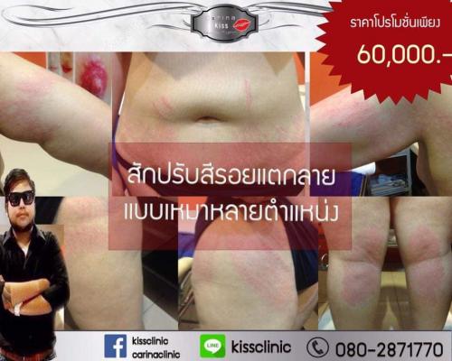 สักปรับสีลบรอยแตกลาย-หายได้โดยช่างมังกร