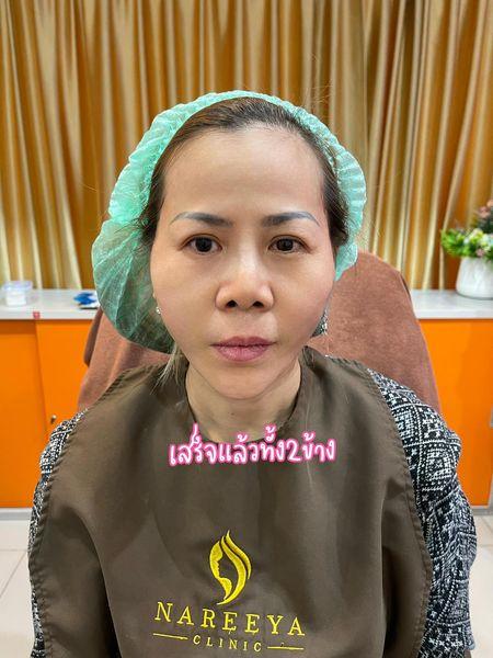 ยกกระชับ-กรอบหน้าวี