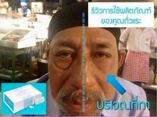 ageless-ถุงใต้ตา-ริ้วรอยใต้ตา-หายไปด้วยราคาประหยัด